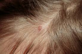 scalp inflammation and hair loss