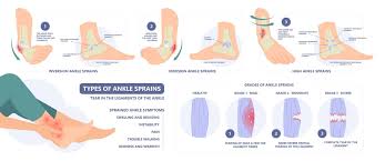 sprained ankle symptoms diagnosis