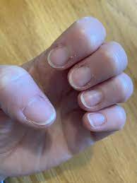 dry skin around nails picture