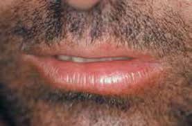 sore or swollen lips part 1 causes and