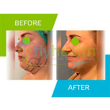 We did not find results for: Chin Liposuction Before And After Photo Gallery Flyhealth