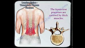 Vertebral fractures of the thoracic and lumbar spine are usually associated with major trauma and can cause spinal cord damage that results in neural deficits. Lumbar Spine Transverse Process Fracture Everything You Need To Know Dr Nabil Ebraheim Youtube