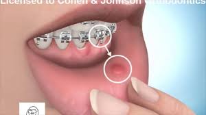 • you should first ensure that your mouth is clean by brushing it and cleaning your hands to ensure that there are no germs. What Is Braces Wax For Its Uses Ways To Apply