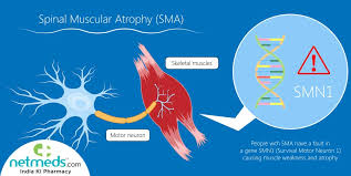 spinal muscular atrophy causes