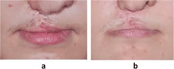 lip scar a before and b after treatment