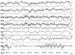 Resultado de imagen de EEG bebe prematuro