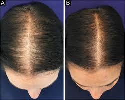 female pattern hair loss theutic
