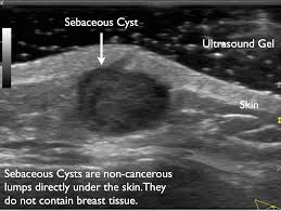 Ultrasound (sonography) depends on having a solid medium (like water or soft tissue) to efficiently transmit the sound here it is important to know that there are some early breast cancers that do not lead to formation of a lump. Beneath The Surface A Guide To Breast Imaging Breast360 Org The American Society Of Breast Surgeons Foundation