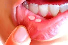 stress triggers recur mouth ulcer