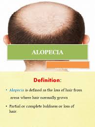 A look at alopecia universalis, a condition resulting in hair loss across the entire body. Alopecia 160716052003 Hair Loss Dermatology