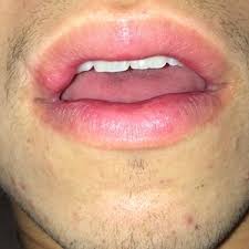 scar p on my lip what can i do photo