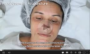 Acupuncture Points Cosmetic Acupuncture Workshops