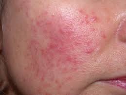 redness and rashes of your skin