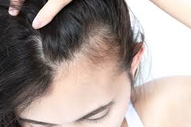 what causes age hair loss