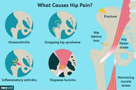 They can be strained or torn by sudden movements or falls. Hip Pain Causes Treatment And When To See A Doctor