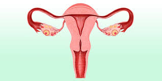 post tubal ligation syndrome women