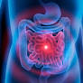 avances sindrome "intestino irritable" "colon irritable" de www.semana.com