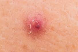 zits ingrown hairs and other ps