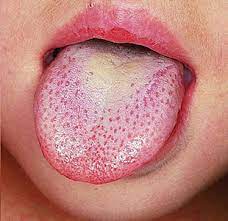 dry mouth causes symptoms prevention