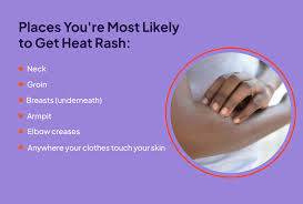 heat rash signs duration and treatment