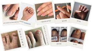 is nail fungus conious preventing