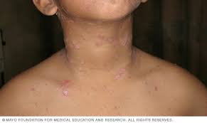 Psoriasis usually appears in early adulthood. Psoriasis Symptoms And Causes Mayo Clinic