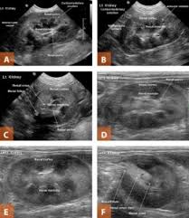 ultrasonography of the urinary tract