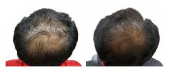 If you're on the hunt for hair growth solutions, pumpkin seed oil may be worth trying, as it's been tied to this benefit in men. Effect Of Pumpkin Seed Oil On Hair Growth In Men With Androgenetic Alopecia A Randomized Double Blind Placebo Controlled Trial