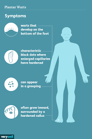 plantar warts