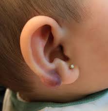 an infant with a tender p on her ear