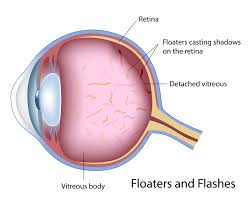 retina health center light flashes in eye