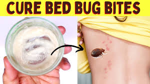 how to get rid of bed bug bites fast