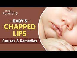 chapped lips in es causes and