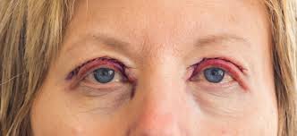 day by day eyelid surgery recovery time