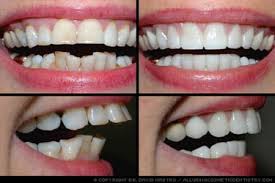 Cosmetic Dentistry: Before-and-After Pictures