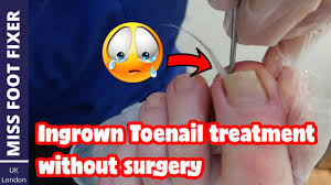 ingrown toenail treatment without