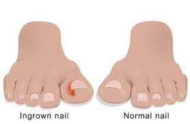 how to treat an ingrown toenail north
