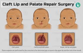 cleft lip and palate repair surgery