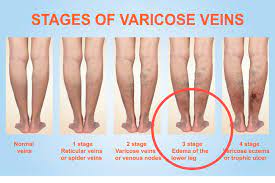 5 hidden dangers of varicose veins