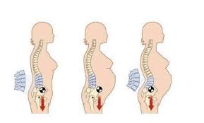 pregnancy back pain posture