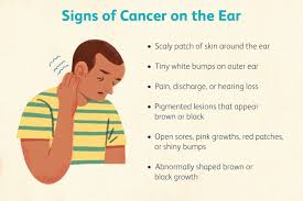 skin cancer of the ear