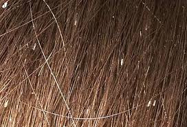 Check spelling or type a new query. Lice Pictures Of What Head Lice Look Like