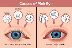 pink eye conjunctivitis causes all