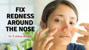 how to fix redness around nose in 3