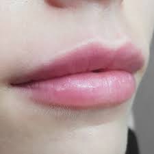 lip filler from 99 lip injections