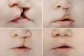cleft lip and cleft palate monroe ent