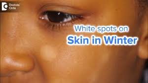 white spots on face in winter causes