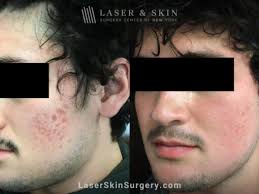 acne acne scar treatment new york ny