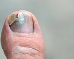 treatment for black or fungal toenails