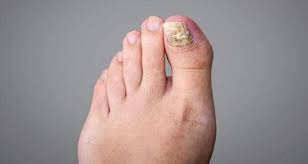 fungal infection in the nails top 10